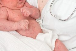 Il parto cesareo raddoppia le probabilità di fallimento del vaccino contro il morbillo