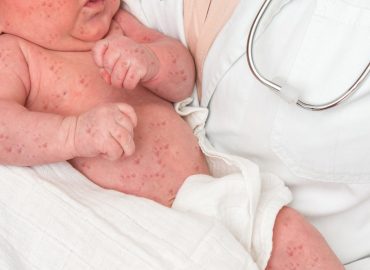 Il parto cesareo raddoppia le probabilità di fallimento del vaccino contro il morbillo