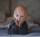 Sammy Basso e la progeria: siamo vicini a sconfiggere la malattia dell’invecchiamento precoce?