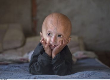 Sammy Basso e la progeria: siamo vicini a sconfiggere la malattia dell’invecchiamento precoce?