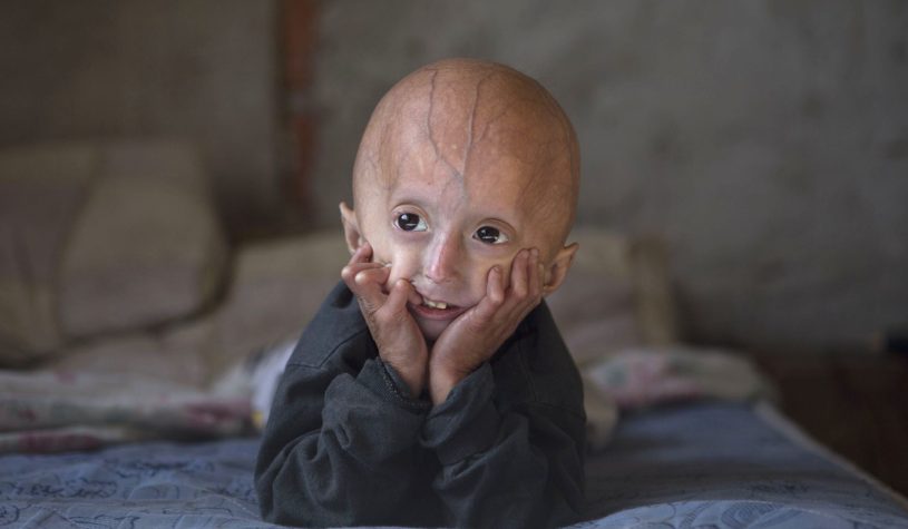 Sammy Basso e la progeria: siamo vicini a sconfiggere la malattia dell’invecchiamento precoce?