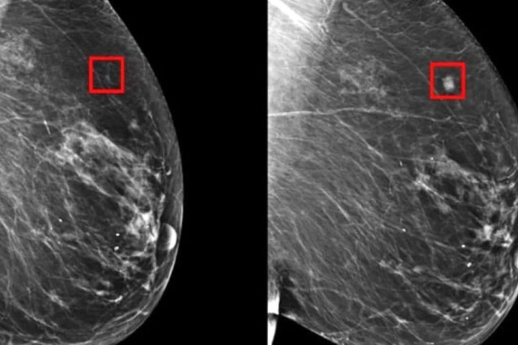 Ai rileva tumore seno cinque anni prima