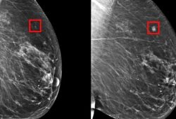 L’intelligenza artificiale può rilevare il cancro al seno con cinque anni di anticipo