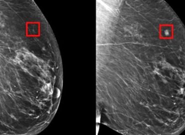L’intelligenza artificiale può rilevare il cancro al seno con cinque anni di anticipo