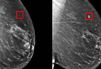 Tumore al seno, così la prevenzione arriva in azienda e l’Ai migliora il percorso di cura