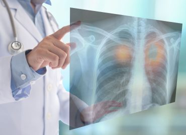 Come un oncologo riduce il rischio di cancro: 5 abitudini chiave