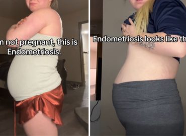 TikToker risponde agli hater: “Non sono incinta, ho solo l’endometriosi”