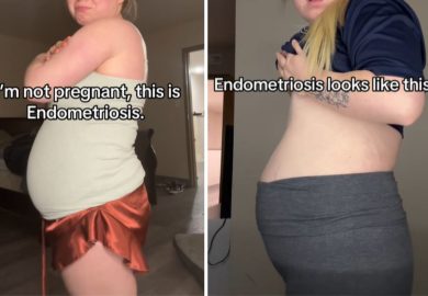 TikToker risponde agli hater: “Non sono incinta, ho solo l’endometriosi”
