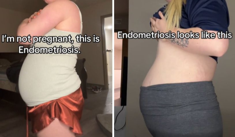 TikToker risponde agli hater: “Non sono incinta, ho solo l’endometriosi”