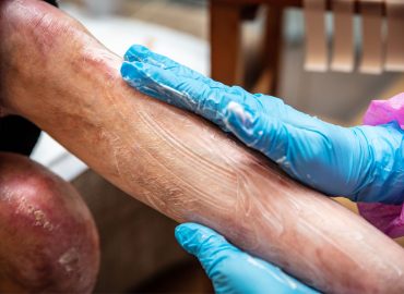 “Bambini farfalla”, dall’Ospedale Bambino Gesù una nuova speranza di cura