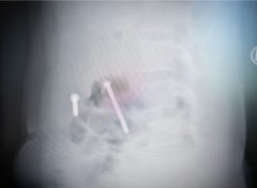 Viti e messaggi di morte nell’utero: le donne tigrè sono state sterilizzate con la forza