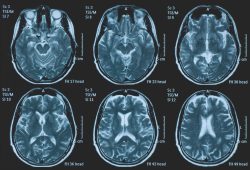 Impatto del Covid-19 sul cervello, i ricercatori: “Invecchiato di 5 mesi”