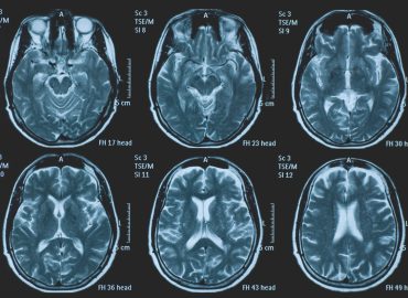 Impatto del Covid-19 sul cervello, i ricercatori: “Invecchiato di 5 mesi”