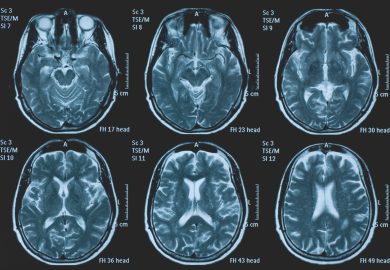 Impatto del Covid-19 sul cervello, i ricercatori: “Invecchiato di 5 mesi”
