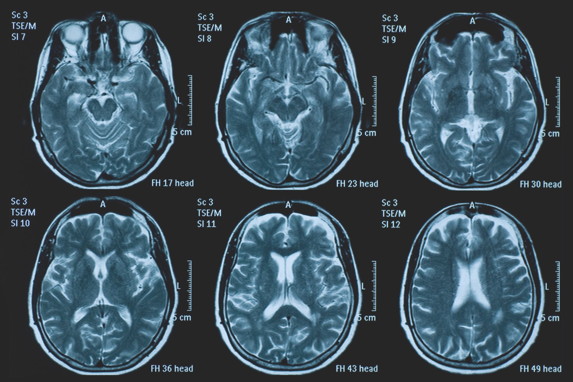 Impatto del Covid-19 sul cervello, i ricercatori: “Invecchiato di 5 mesi”