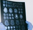 Alzheimer, scoperta una correlazione tra fecondità e demenza 