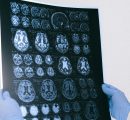 Alzheimer, un “metallo” aiuta a rallentare la patologia