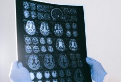Alzheimer, un “metallo” aiuta a rallentare la patologia