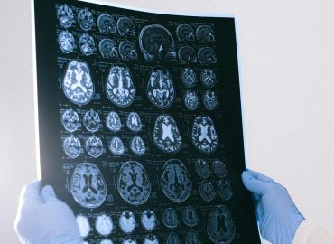 Alzheimer, un “metallo” aiuta a rallentare la patologia