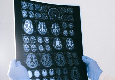 Alzheimer, scoperta una correlazione tra fecondità e demenza 