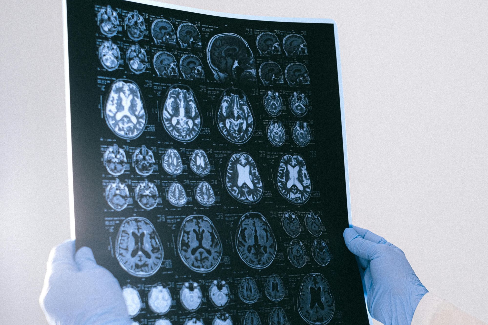 Alzheimer, un “metallo” aiuta a rallentare la patologia