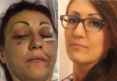 Sfigurata dall’ex marito, l’uomo non andrà in carcere: “Lei ha sfaldato il matrimonio”