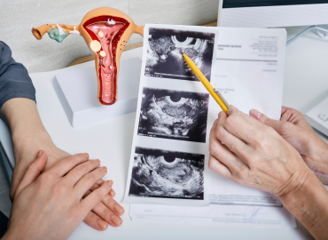 Sindrome dell’ovaio policistico, 7 donne su 10 restano senza diagnosi