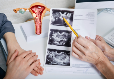 Sindrome dell’ovaio policistico, 7 donne su 10 restano senza diagnosi