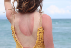 Scottature solari come trofei: la follia social dell’estate