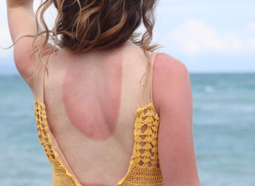 Scottature solari come trofei: la follia social dell’estate