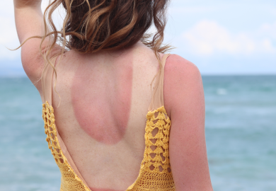 Scottature solari come trofei: la follia social dell’estate