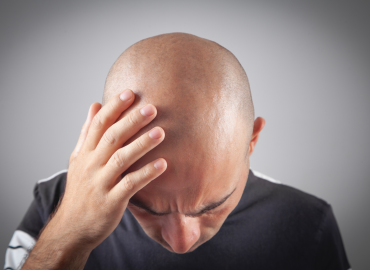 L’Italia è il secondo Paese al mondo per numero di uomini calvi: cosa ci dice (davvero) questo dato