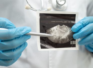 Trasposizione uterina, primo caso in Italia: cos’è e perché è importante per la fertilità?