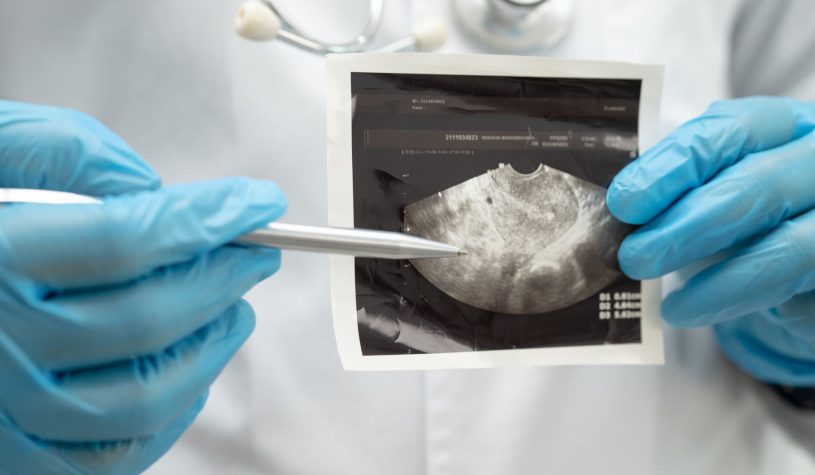 Trasposizione uterina, primo caso in Italia: cos’è e perché è importante per la fertilità?