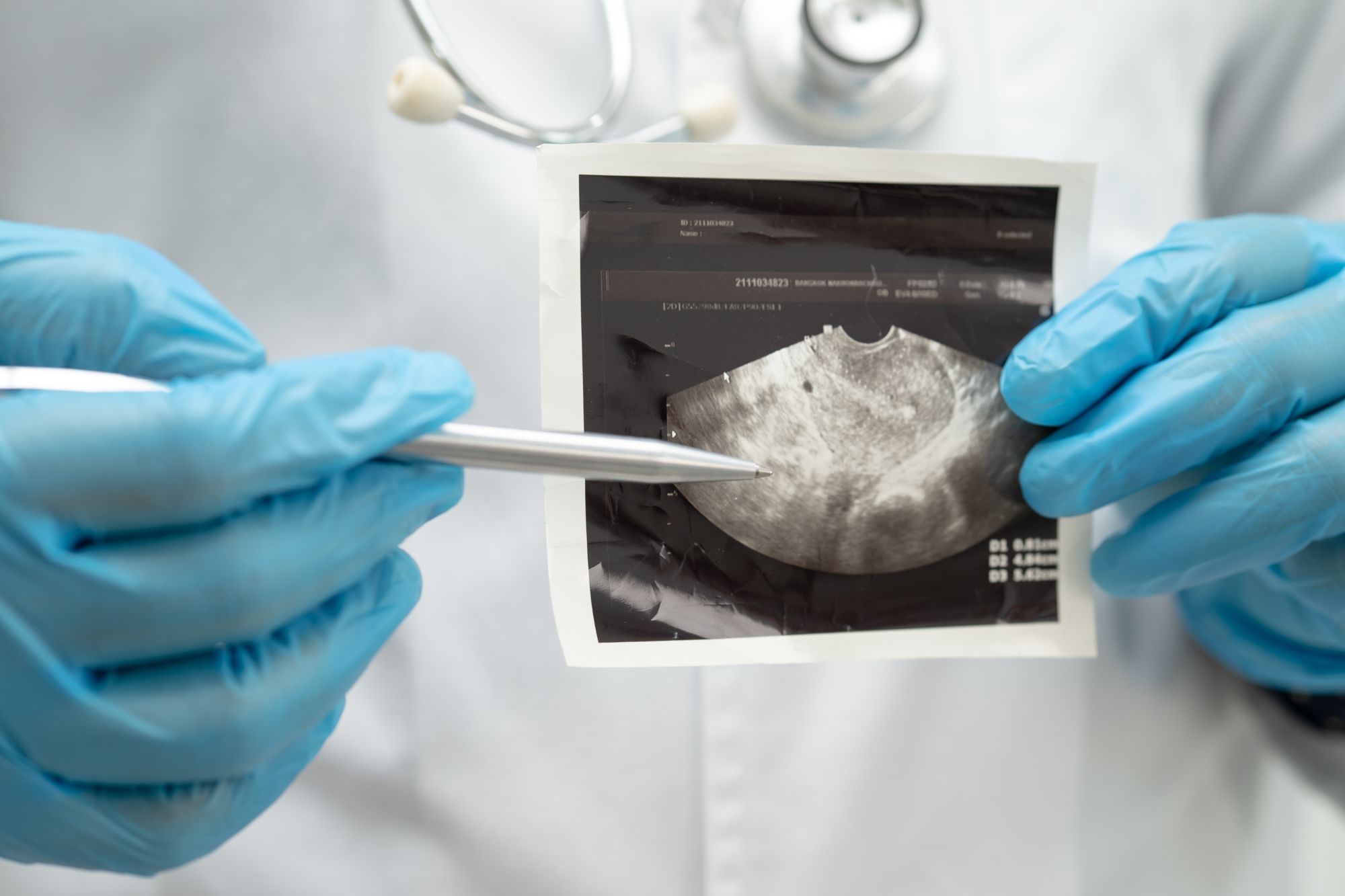 Trasposizione uterina, primo caso in Italia: cos’è e perché è importante per la fertilità?