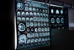 Leggere il pensiero con il suono, una startup sfida Neuralink di Musk con gli ultrasuoni