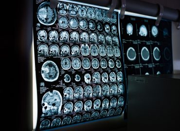 Leggere il pensiero con il suono, una startup sfida Neuralink di Musk con gli ultrasuoni