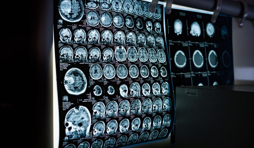 Leggere il pensiero con il suono, una startup sfida Neuralink di Musk con gli ultrasuoni