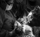 Vaginal seeding: si può imitare il microbioma del parto naturale?