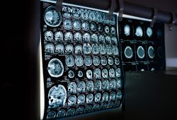 Cervello maschile e femminile: la differenza (sottile) è scritta nei geni