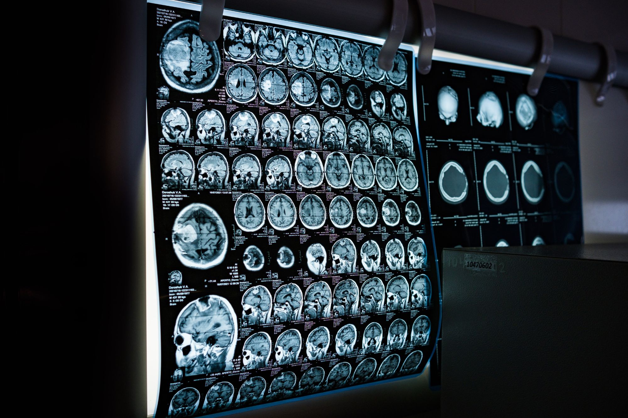 Cervello maschile e femminile: la differenza (sottile) è scritta nei geni