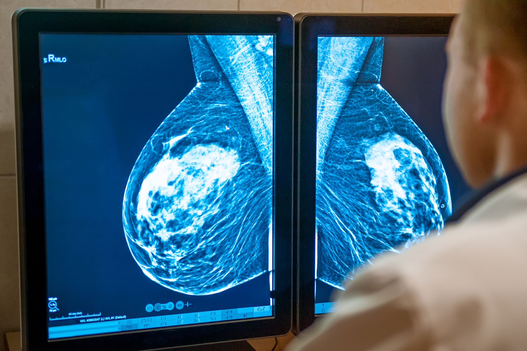 A 72 minuti da una mammografia: nell’entroterra siciliano solo 4 donne su 10 arrivano allo screening