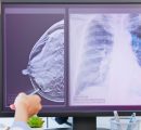 L’intelligenza artificiale scopre le malattie cardiache dalla mammografia