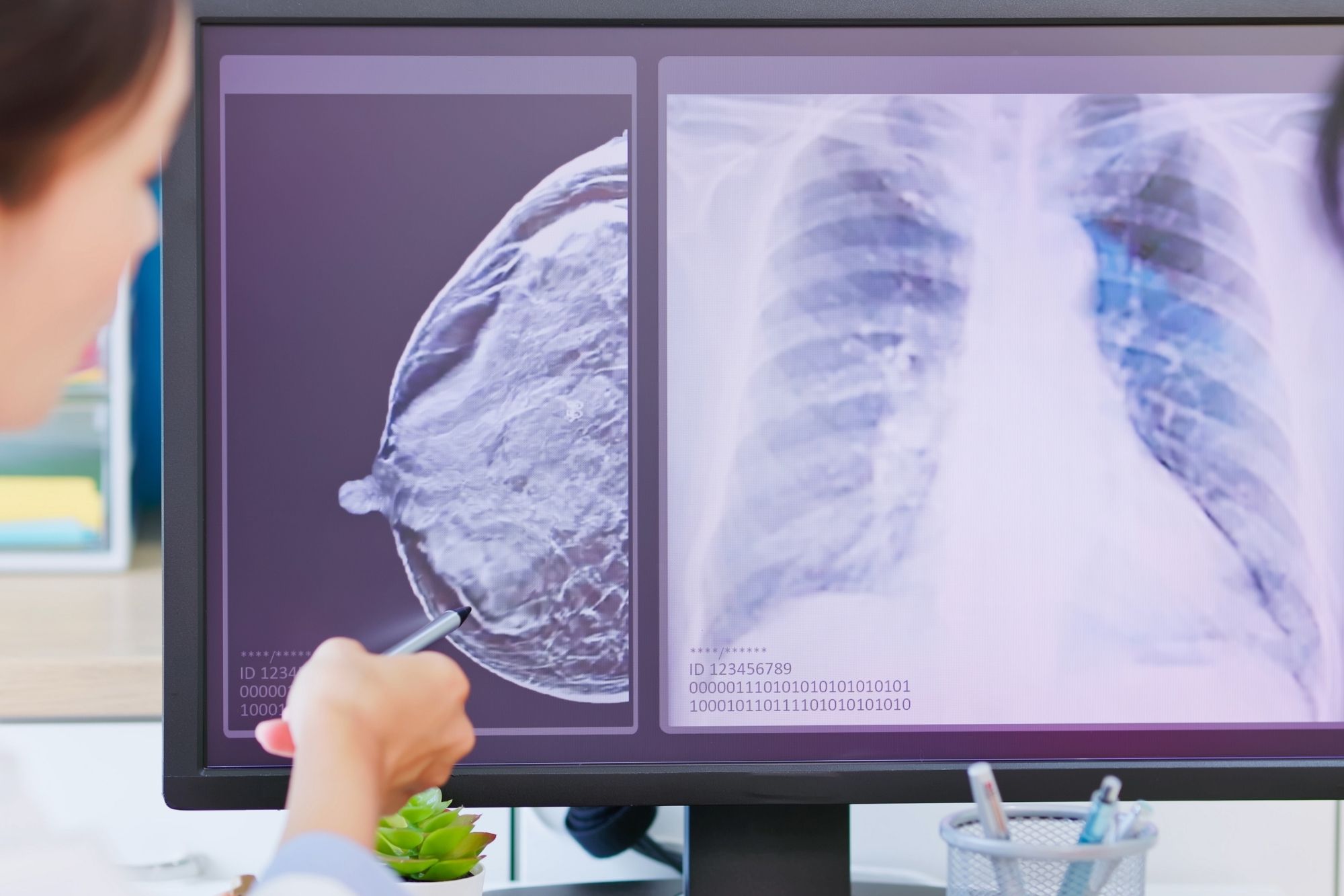 L’intelligenza artificiale scopre le malattie cardiache dalla mammografia
